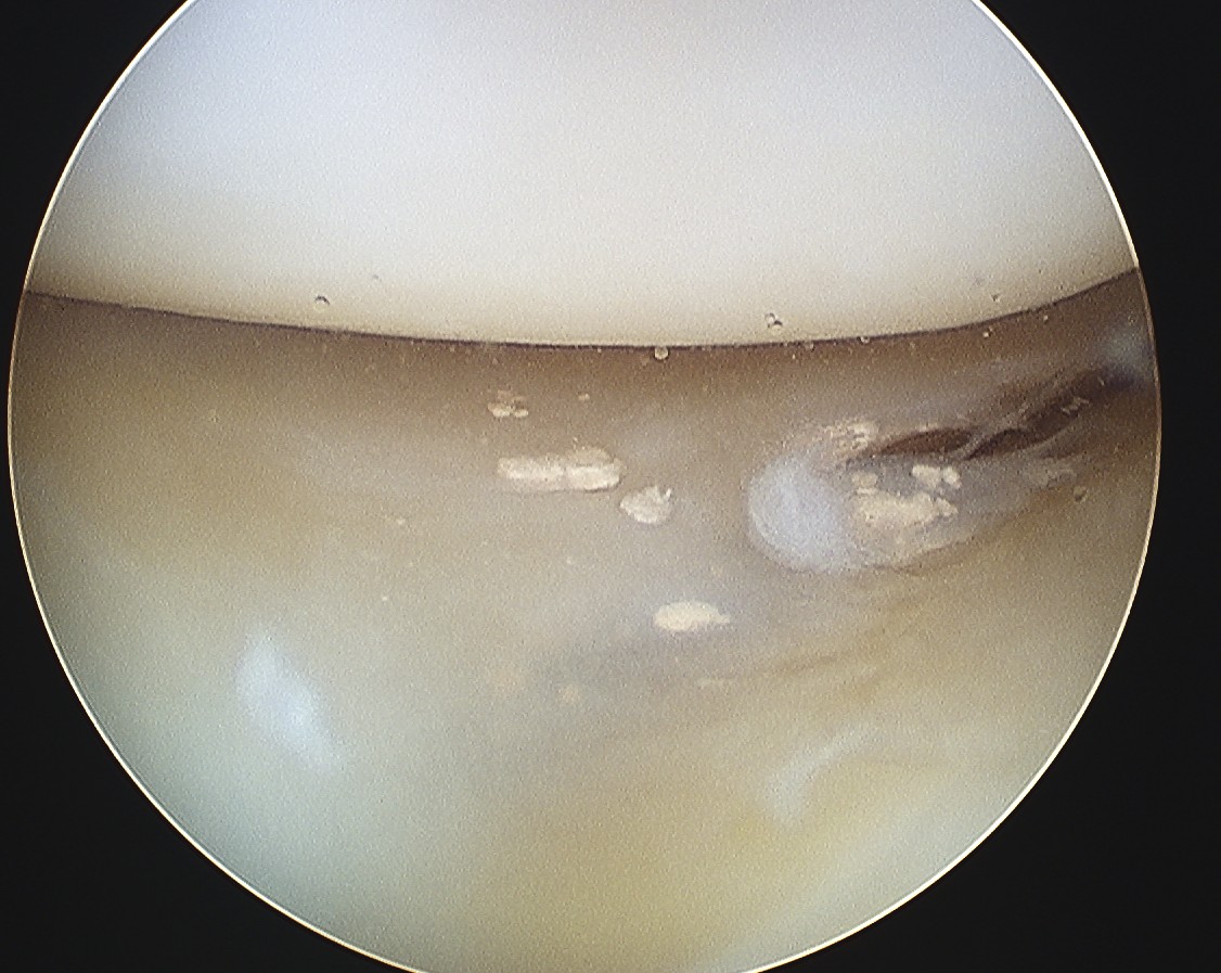 Chondrocalcinosis knee scope